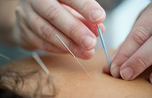 acupuncturist working on client