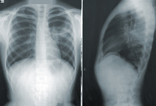 Spinal X-ray