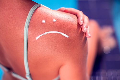 Customer skin burn from tanning bed